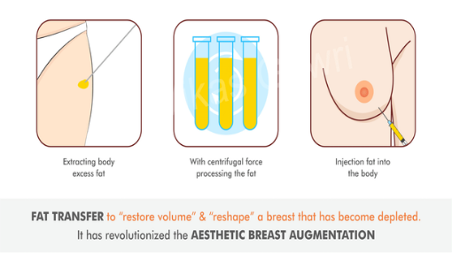 Fat Transfer to Breast