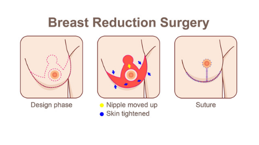 Breast Reduction