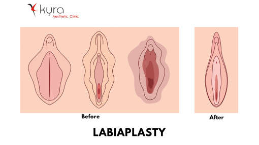 Labiaplasty