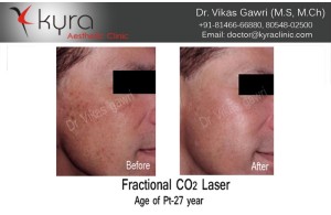 Fractional CO2 Laser DEKA