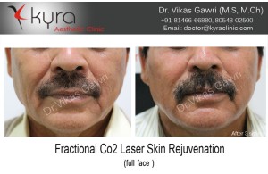 Fractional CO2 Laser DEKA