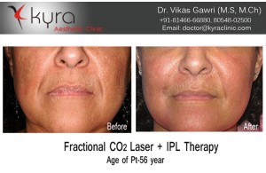 Fractional CO2 Laser DEKA