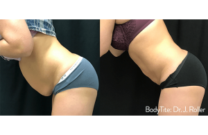 Power Assisted Liposuction