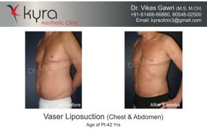 Ultrasonic Liposuction – LYSONIX