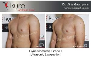 Ultrasonic Liposuction – LYSONIX