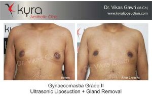 Ultrasonic Liposuction – LYSONIX