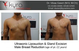 Ultrasonic Liposuction – LYSONIX