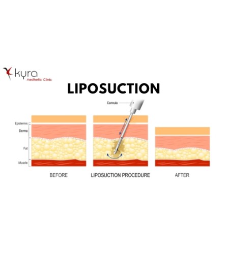 Liposuction